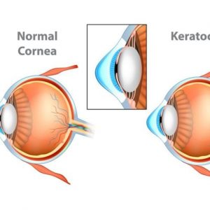 Il cheratocono e il suo effetto sulla visione