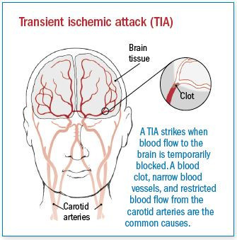 Attacco ischemico transitorio (TIA) 1