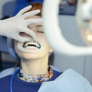 Lo sbiancamento dei denti è sicuro ed efficace?