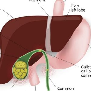 Trattamento dei calcoli biliari