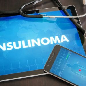 Insulinomi: tumori benigni del pancreas