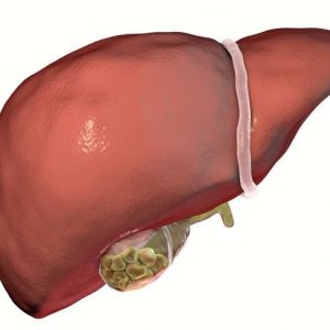 10 Sintomi e trattamenti dei calcoli vescicali