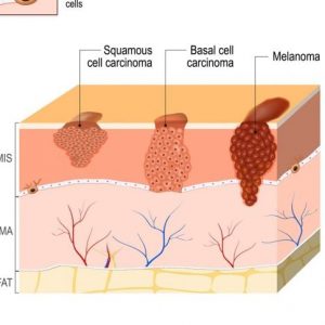 Che cos’è il carcinoma a cellule squamose?