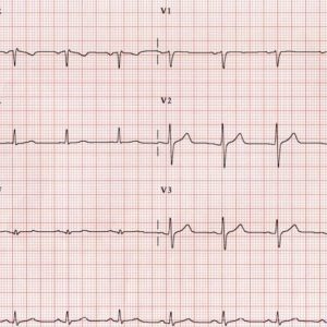 Che cos’è un elettrocardiogramma?