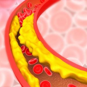 Comprendere e combattere l’arteriosclerosi