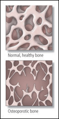 Osteoporosi 1
