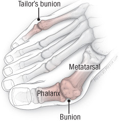 Bunion