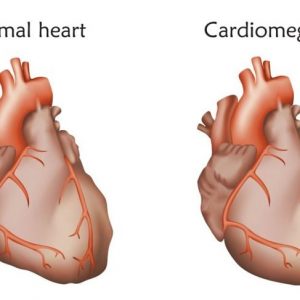 Che cos’è un cuore ingrossato?