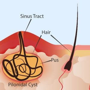 Che cos’è il seno pilonidale