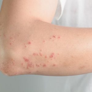 Quanto è contagioso l’herpes zoster?